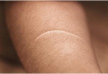 What Causes Keloids and What Can I Do About Them? Causes Keloids