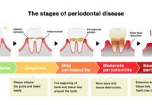 Does gum disease prevent me from getting dental implants? Figure 1 Illustration showing various progressive stages of periodontitis