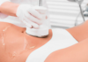 Venus Legacy Fat Reduction: Benefits, Results and Treatment Options Venus Legacy fat reduction