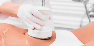 Venus Legacy Fat Reduction: Benefits, Results and Treatment Options Venus Legacy fat reduction