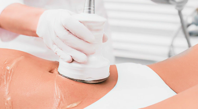 Venus Legacy Fat Reduction: Benefits, Results and Treatment Options Venus Legacy fat reduction
